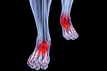 Arthritic foot and ankle care treatment in the Orange County, FL: Orlando (Fairview Shores, Pine Hills, Maitland, Winter Park, Pineloch, Holden Heights, Edgewood, Baldwin Park, Conway, Goldenrod, Eatonville, Lockhart, Orlovista, Azalea Park) areas