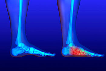 Flat feet and Fallen Arches treatment in the Orange County, FL: Orlando (Fairview Shores, Pine Hills, Maitland, Winter Park, Pineloch, Holden Heights, Edgewood, Baldwin Park, Conway, Goldenrod, Eatonville, Lockhart, Orlovista, Azalea Park) areas