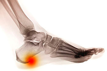 Heel spurs treatment in the Orange County, FL: Orlando (Fairview Shores, Pine Hills, Maitland, Winter Park, Pineloch, Holden Heights, Edgewood, Baldwin Park, Conway, Goldenrod, Eatonville, Lockhart, Orlovista, Azalea Park) areas