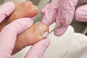 Ingrown toenails treatment and restoration in the Orange County, FL: Orlando (Fairview Shores, Pine Hills, Maitland, Winter Park, Pineloch, Holden Heights, Edgewood, Baldwin Park, Conway, Goldenrod, Eatonville, Lockhart, Orlovista, Azalea Park) areas