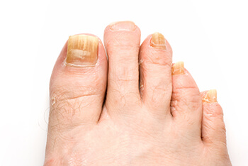 Fungal toenails treatment in the Orange County, FL: Orlando (Fairview Shores, Pine Hills, Maitland, Winter Park, Pineloch, Holden Heights, Edgewood, Baldwin Park, Conway, Goldenrod, Eatonville, Lockhart, Orlovista, Azalea Park) areas