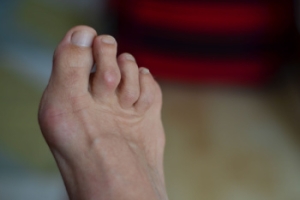 Symptoms and Treatment of Hammertoe