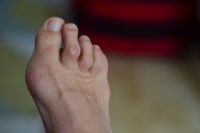 Symptoms and Treatment of Hammertoe
