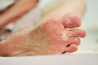 Plantar Warts May Grow in Clusters