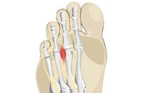 Symptoms of Morton’s Neuroma