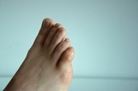 Types and Causes of Foot Corns