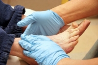 Simple Steps for Diabetic Foot Care