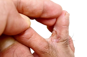 Causes and Diagnosis of Athlete&#039;s Foot