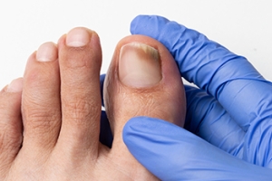 What Causes Toenail Fungus?