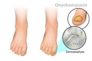 What Are the Causes and Symptoms of Toenail Fungus?