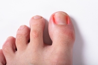 Risk Factors for Ingrown Toenails