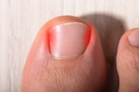 An Infected Ingrown Toenail