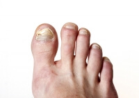 Ignoring Toenail Fungus Can Be Harmful