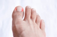 Children, Toe Pain, and Ingrown Toenails